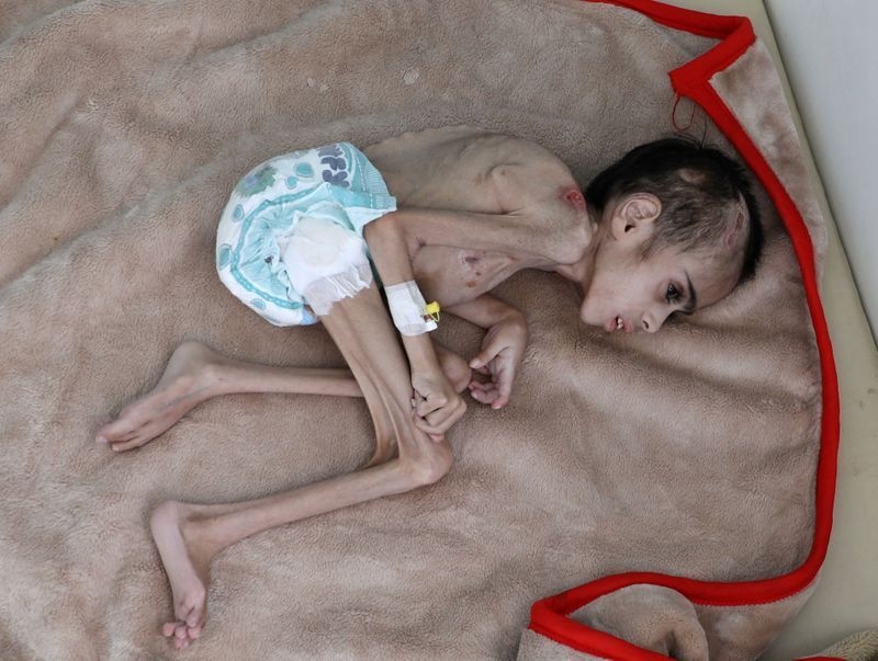 Cau be Yemen 7 tuoi chi nang 7 kg vi nan doi hinh anh