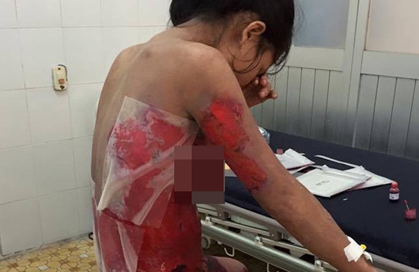 Tổn thương trên da chị Bích do bị bọ cạp đốt.