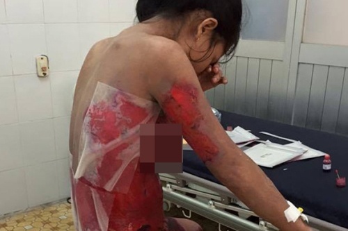 Nguy kich vi tu mua thuoc dieu tri 2 vet can cua bo cap doc hinh anh