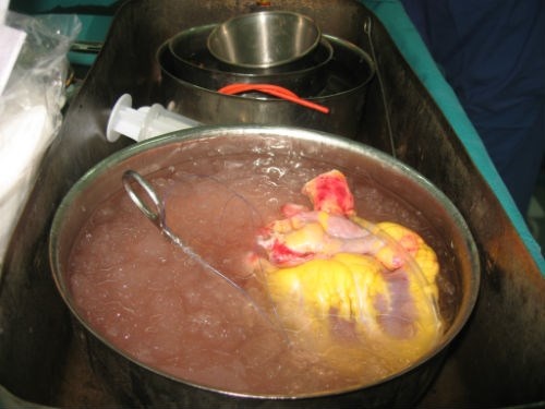 Can canh ca ghep tim tai Benh vien Viet Duc hinh anh