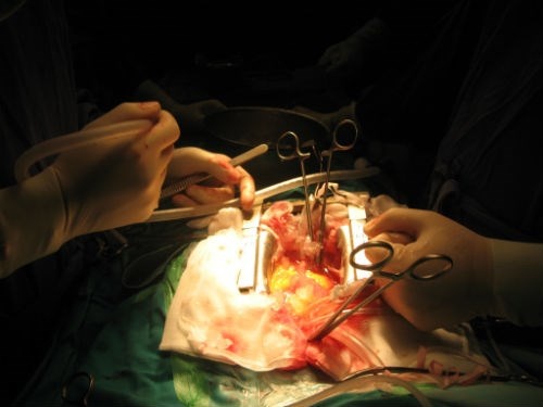 Khác với ghép tạng khác, ghép tim mục đích là giúp trái tim có nhịp đập, các bác sĩ phải khéo léo đưa các miệng nối làm sao để tim ghép đã tự động đập trở lại. 