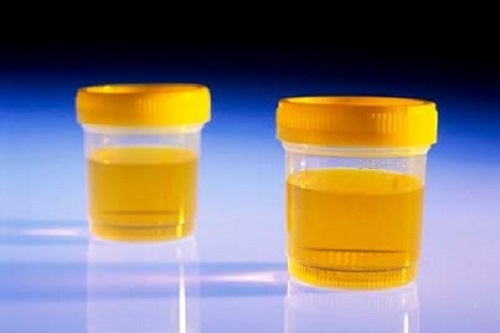 Xet nghiem nuoc tieu co the phat hien ung thu hinh anh