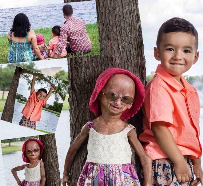 Ảnh: Adalia Rose bên cạnh em trai và bố mẹ. Cô bé có một cuộc sống lạc quan giàu tình cảm khiến nhiều người ngưỡng mộ.