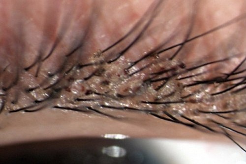 Phat hien hon 20 con ran mu tren long mi be gai 4 tuoi hinh anh