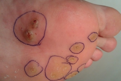 Chua chai chan: Nen khoet bo hay chua meo? hinh anh