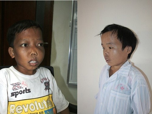 Can benh an trong cong dong nhu qua bom nguyen tu hinh anh