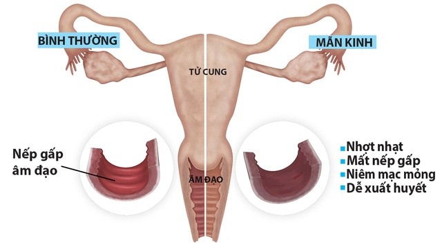 Khô âm đạo là nỗi ám ảnh của nhiều phụ nữ khi bước qua tuổi trung niên.