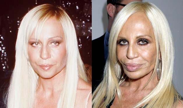 6. Donatella Versace: Nhà thiết kế thời trang nổi tiếng của thương hiệu Versace là một trong những tín đồ nghiện trùng tu nhan sắc. Tuy nhiên, thay vì trở nên xinh đẹp, bà lại là thảm họa thẩm mỹ ở Hollywood. Theo nhận định của các bác sĩ phẫu thuật ở New York, bà đã nâng mũi, bơm môi, căng da mặt, tiêm chất độn và botox. Đôi môi phình to, mũi hẹp, cơ mặt khó cử động là những điểm biến dạng trên khuôn mặt của Donatella. Ảnh: Womansday