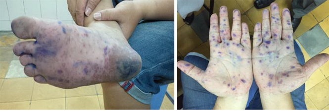 Ban đỏ ở lòng bàn tay, lòng bàn chân - Ảnh: Bệnh viện Đa khoa sài Gòn cung cấp