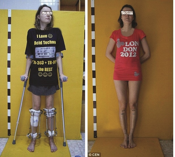 Noi dai chan tham my bang ky thuat Illizarov hinh anh