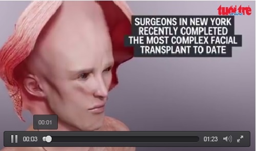 Video ve phau thuat ghep mat cua Patrick Hardison hinh anh