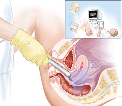 Siêu âm đầu dò âm đạo giúp phát hiện bệnh