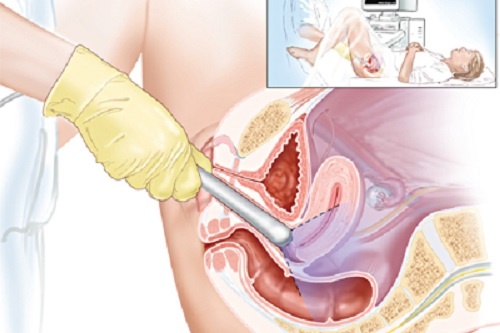 Dau hieu phat hien som ung thu am dao hinh anh