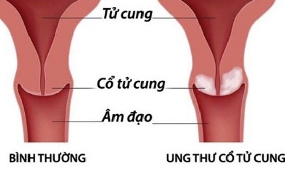 Dau hieu ung thu co tu cung ban can biet hinh anh