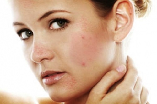 Nguyen nhan bi mun trung ca nhieu vao mua dong hinh anh