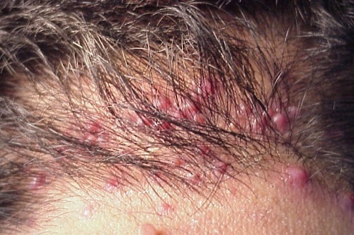 Thuoc tri benh viem nang long hinh anh