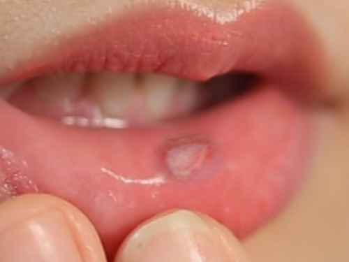 Bi quyet phong ngua loet mieng tai phat hinh anh