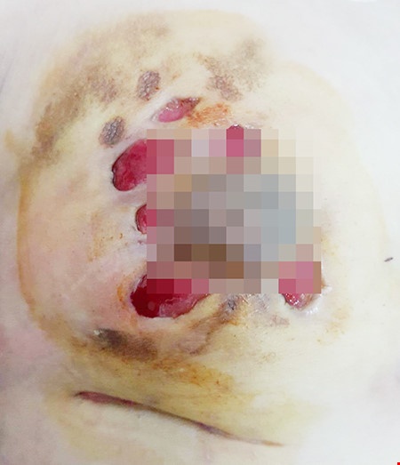 Nâng ngực bằng silicon ảnh 2 Nang nguc bang silicon anh 2