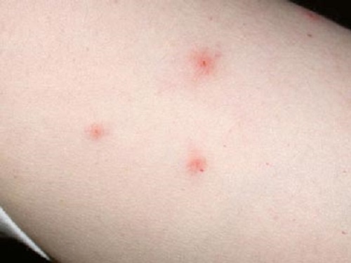 Xu tri cac vet con trung dot hinh anh