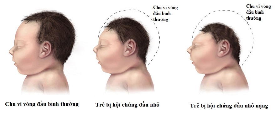 Hội chứng đầu nhỏ ảnh 1 Hoi chung dau nho anh 1