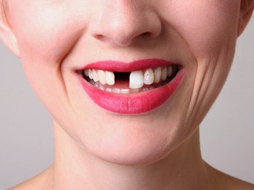 Xu ly sut rang do nga hinh anh