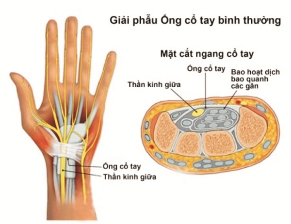 Hội chứng ống cổ tay ảnh 1 Hoi chung ong co tay anh 1