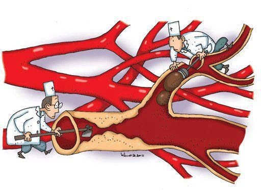 Những điều cần biết về bệnh cao huyết áp ảnh 1 Nhung dieu can biet ve benh cao huyet ap anh 1