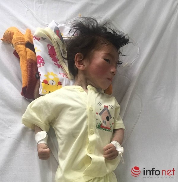 Be gai suy dinh duong 14 thang nang 3, 5 kg anh 1