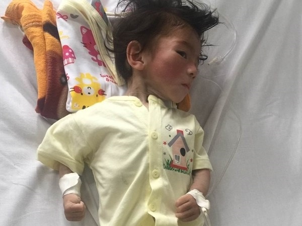 Be gai suy dinh duong 14 thang nang 3,5 kg hinh anh