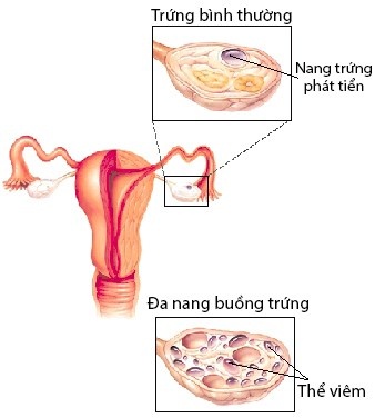 Uống thuốc tránh thai mới có "đèn đỏ" ảnh 1 Uong thuoc tranh thai moi co "den do" anh 1