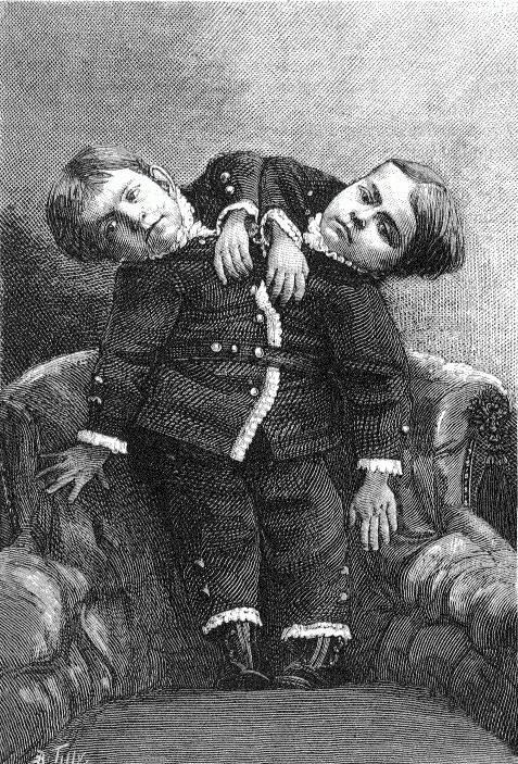 Cap song sinh dinh lien tren the gioi anh 1