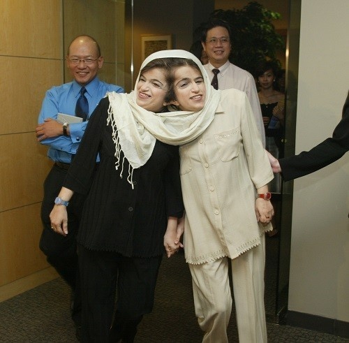 Cap song sinh dinh lien tren the gioi anh 2