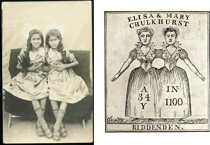 Cap song sinh dinh lien tren the gioi anh 5