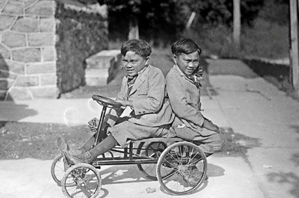 Cap song sinh dinh lien tren the gioi anh 9