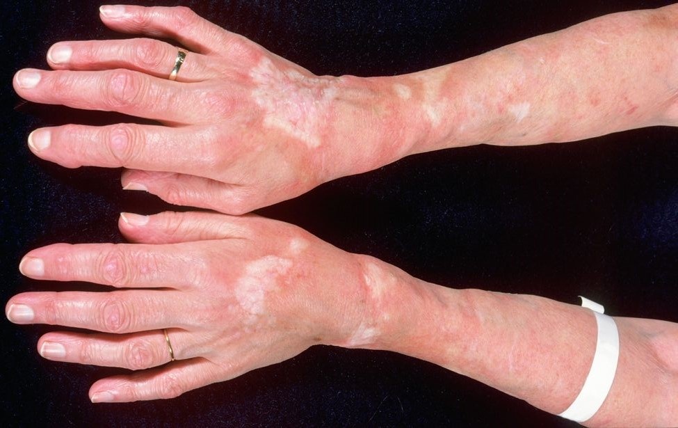 Nhung thay doi tren da canh bao benh anh 6