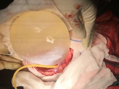 Nang san lon nhat lich su y hoc trong dau be 12 tuoi hinh anh