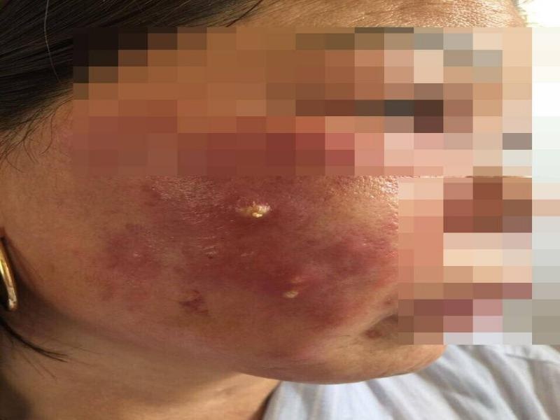 Lam dep bang tiem thuoc trang da: Hai me con nhap vien hinh anh