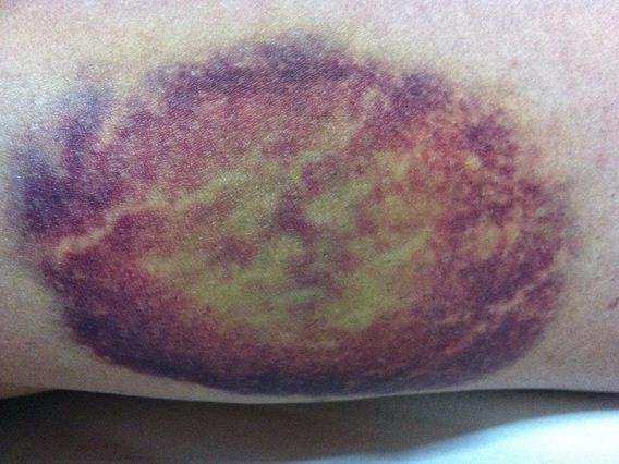 Canh giac voi not bam tim tren co the hinh anh