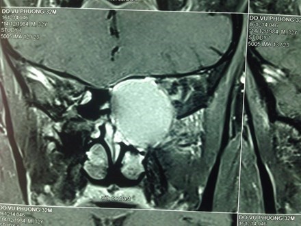 Suyt mu vinh vien vi khoi u nhay hinh anh