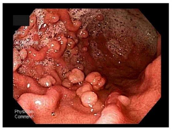 Bệnh polyp đại trực tràng tuyến ảnh 1 Benh polyp dai truc trang tuyen anh 1