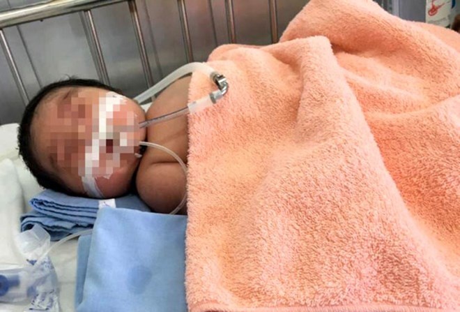 Trẻ bị tiểu đường sơ sinh ảnh 1 Tre bi tieu duong so sinh anh 1