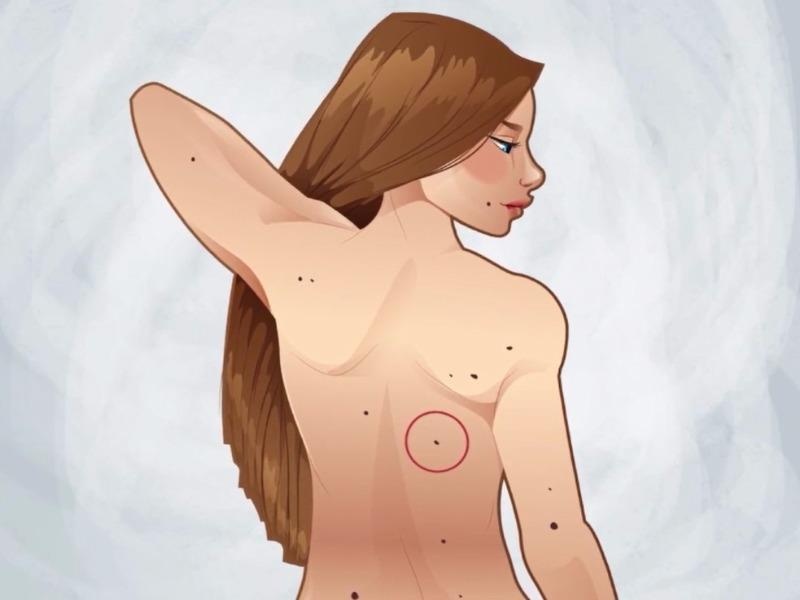 Dau hieu bat thuong cua not ruoi canh bao benh ung thu da hinh anh