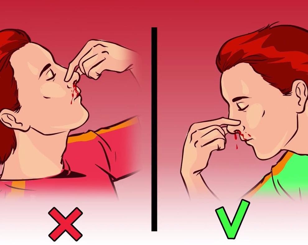 Sai lam khi xu ly chay mau cam nhieu nguoi mac phai hinh anh