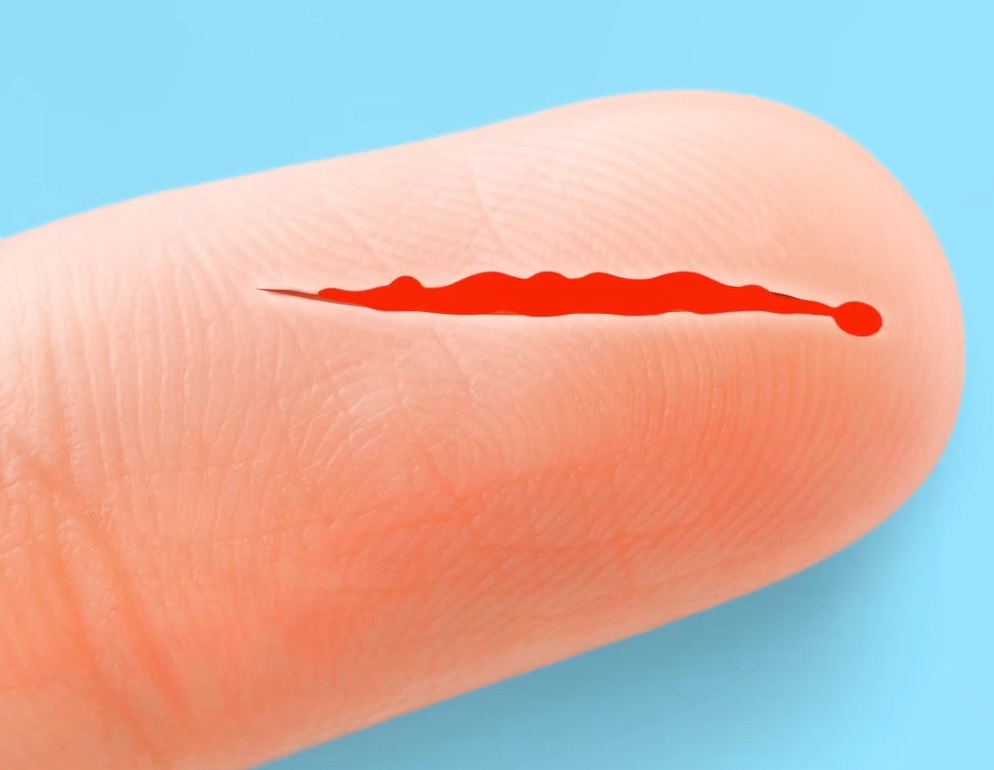 Dieu gi xay ra neu ban bi dut tay? hinh anh