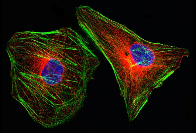 Benh ung thu duoi kinh hien vi anh 2