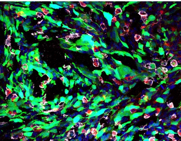 Benh ung thu duoi kinh hien vi anh 4