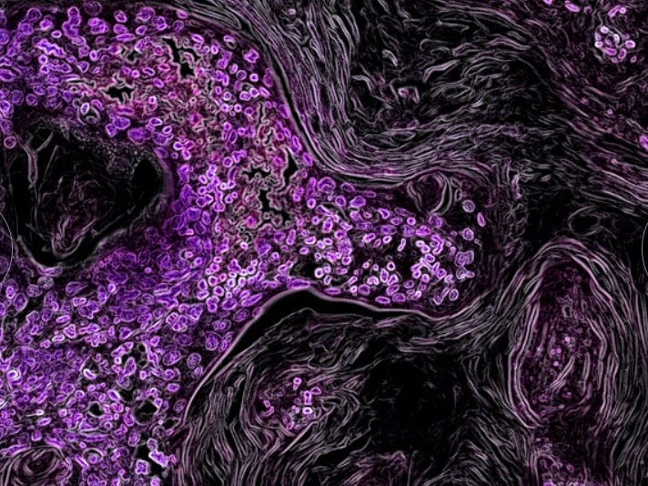 Benh ung thu duoi kinh hien vi anh 7