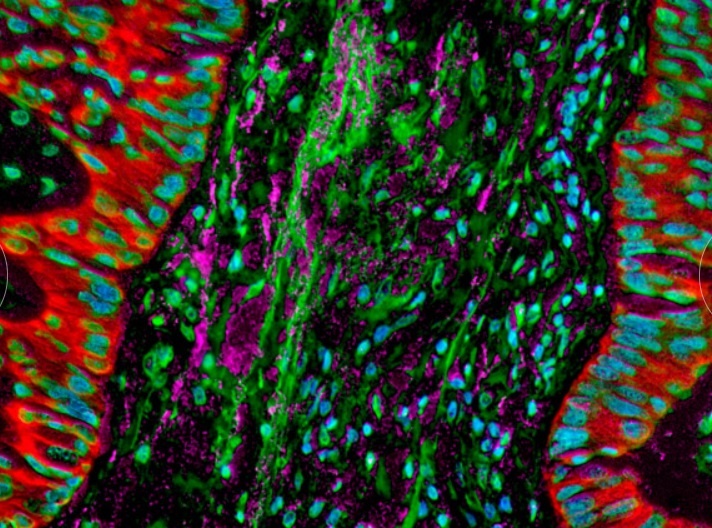 Benh ung thu duoi kinh hien vi anh 8