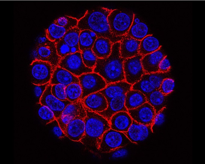 Benh ung thu duoi kinh hien vi anh 9