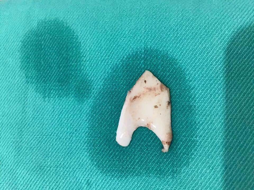 Gap xuong dai 2,5 cm ra khoi thuc quan benh nhan hinh anh